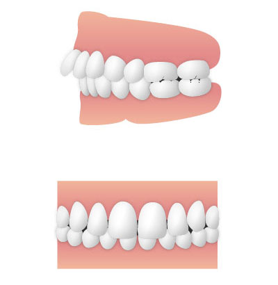 出っ歯(上顎前突)