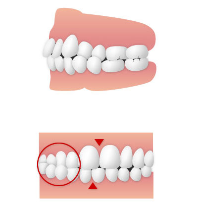 クロスバイト(交叉咬合)