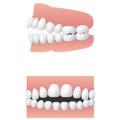 オープンバイト(開咬)